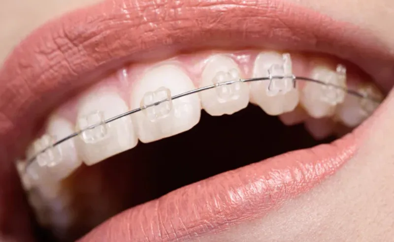 Clear / Ceramic Braces